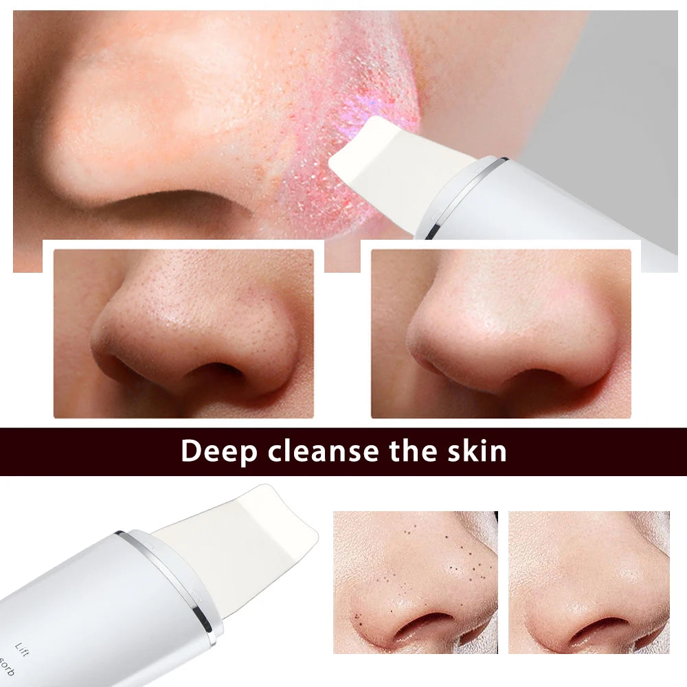 Ultrasonic Deep Cleansing Facial Spatula – Blackhead Exfoliating Shovel & EMS Lifting Device