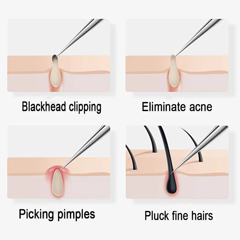 Professional Stainless Steel Blackhead Removal Set (4–5 Pcs) – Acne Needles & Precision Tweezers